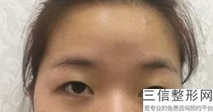 蚌埠开眼角美容整形医院排名榜前六明确了,蚌埠哪家医院割双眼皮好