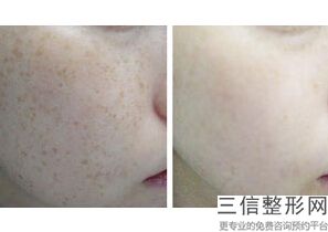 保定热玛吉官方授权医院口碑排行榜名单介绍,做热玛吉哪家医院好