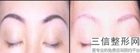 宝鸡割双眼皮医院排名榜top5深度点评,宝鸡割双眼皮哪家医院排行