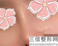 北京鼻部三甲整形医院排名,北京整形鼻子良好的公立医院