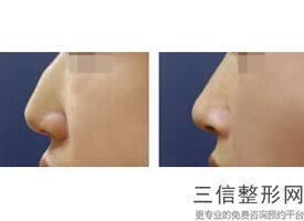 北京鼻部整形医院排行榜top10权威汇总,北京鼻子整形美容医院