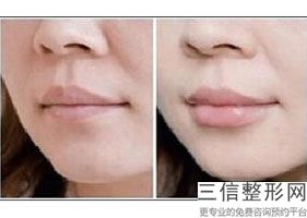 北京唇部整形医院十佳排名榜全新汇总,北京嘴唇整形医院哪家好