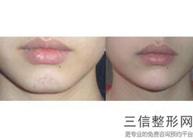 北京唇部整形医院十佳排名榜全新汇总,北京嘴唇整形医院哪家好