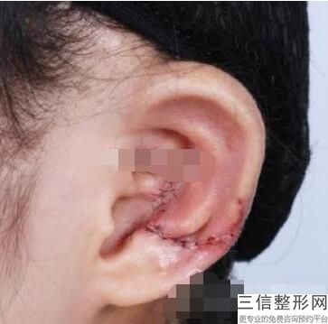 北京耳朵整形医院排行榜前十公立版,全国良好的整形医院