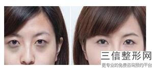 北京割双眼皮好的十大整形医院排名榜公示,北京北京割双眼皮哪个医院好
