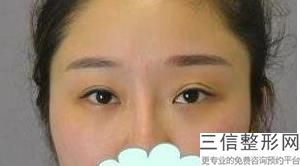 北京割双眼皮好的十大整形医院排名榜公示,北京北京割双眼皮哪个医院好
