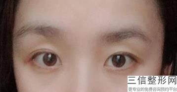 北京割双眼皮医院排名榜top7权威汇总,北京哪家医院割双眼皮手术比较好