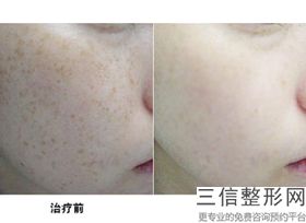 北京公立医院拉皮排行前十及价格公示,北京哪家医院做拉皮手术比较好