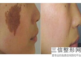 北京公立医院拉皮排行前十及价格公示,北京哪家医院做拉皮手术比较好
