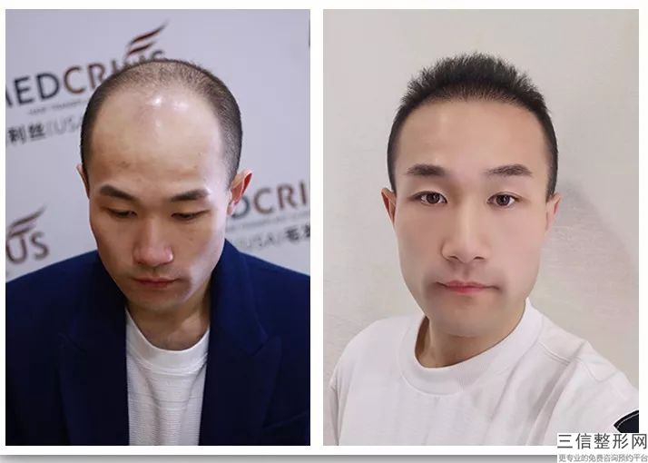 北京好的植发医院排名榜前六口碑测评,北京植发哪个医院好