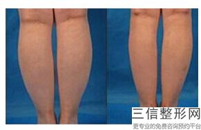 北京假体丰臀医院排名前十这几家名气很大,假体丰胸良好的医院