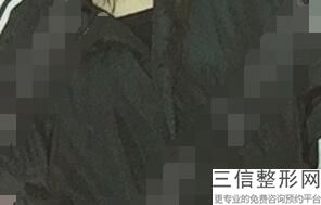 北京假体隆胸医院排名前十大公开,假体隆胸有名医院