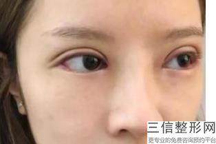 北京近视眼手术医院排名前四,北京近视眼手术哪家医院做的比较好