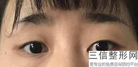 北京近视眼手术医院排名前四,北京近视眼手术哪家医院做的比较好