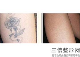 北京拉皮手术专家排行名单出示,北京拉皮手术哪家医院好