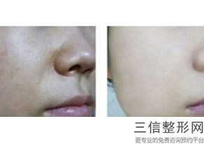 北京拉皮手术专家排行名单出示,北京拉皮手术哪家医院好