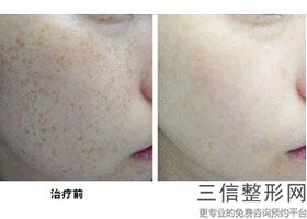 北京拉皮手术专家排名前十综合,拉皮手术医生排名