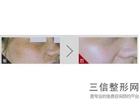 北京拉皮手术专家排名前十综合,拉皮手术医生排名