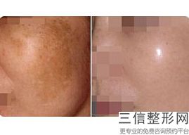 北京拉皮医院排名榜前六权威发布,北京哪家整形医院做拉皮手术良好