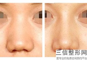 北京隆鼻哪个专家技术好,北京隆鼻比较好的医生