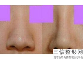 北京隆鼻哪个专家技术好,北京隆鼻比较好的医生