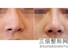 北京隆鼻哪个专家技术好,北京隆鼻比较好的医生