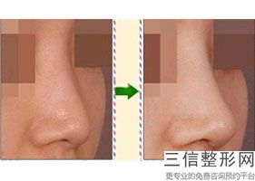 北京隆鼻排名前十的整形医院名单发布,北京鼻子整形医院排名