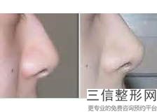 北京隆鼻三甲公立医院排行榜名单介绍,北京整鼻子三甲医院