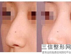 北京隆鼻三甲医院排行榜公立名次更新,北京隆鼻医生排名