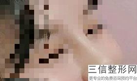 北京隆鼻十大专家名单发布,北京医院隆鼻