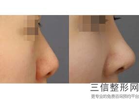 北京隆鼻十大专家名单发布,北京医院隆鼻
