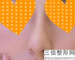 北京隆鼻十大专家名单发布,北京医院隆鼻