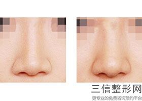 北京隆鼻十大专家名单发布,北京医院隆鼻