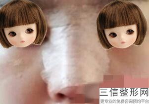北京隆鼻医生排名榜前十,北京隆鼻比较好的医生