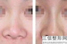北京隆鼻医生前十名排行榜更新啦,北京鼻子整形医生排名