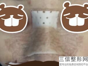 北京隆鼻医院排名前十抢先预览,北京隆鼻哪个医院好