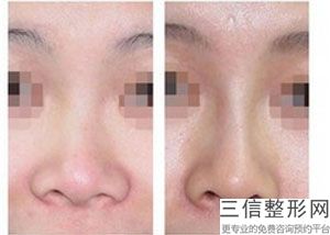 北京隆鼻整形医院排名前八口碑榜公布,北京隆鼻医生排行榜