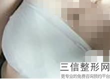北京隆胸手术整形医院排名前五权威点评,北京隆胸良好的医院