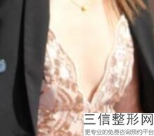 北京隆胸手术整形医院排名前五权威点评,北京隆胸良好的医院