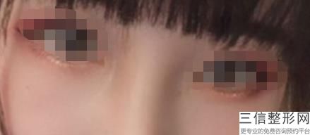 北京埋线双眼皮整形医院排名前五权威发布,双眼皮埋线 北京医院价格