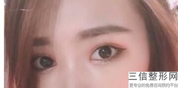 北京埋线双眼皮整形医院排名前五权威发布,双眼皮埋线 北京医院价格