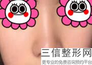 北京哪家私立医院隆鼻好,北京隆鼻三甲公立医院