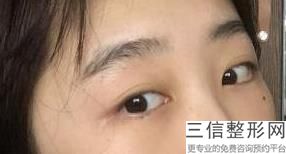 北京全切双眼皮医院排名榜前十发布,北京哪家医院割双眼皮良好