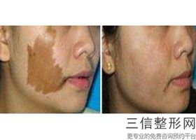 北京热玛吉官方授权医院哪家好,北京热玛吉官方授权医院查询
