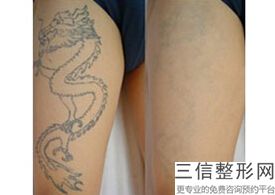 北京热玛吉官方授权医院排行榜发布,北京热玛吉正规医院哪家好