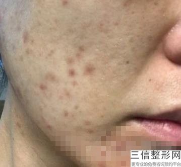 北京热玛吉官方授权医院排行榜发布,北京热玛吉正规医院哪家好