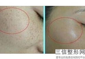 北京热玛吉官方授权医院排行榜发布,北京热玛吉正规医院哪家好