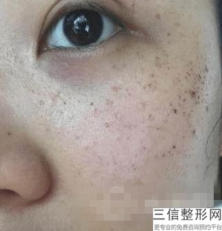 北京热玛吉官方授权医院排行榜发布,北京热玛吉正规医院哪家好
