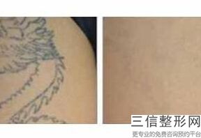 北京热玛吉官方授权医院这里查询一二,北京热玛吉正规医院