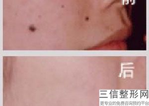 北京热玛吉认证医院排行榜前五名单查看,热玛吉认证医生和认证医院